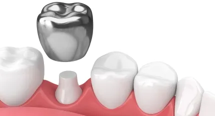 Metal Dental Crowns